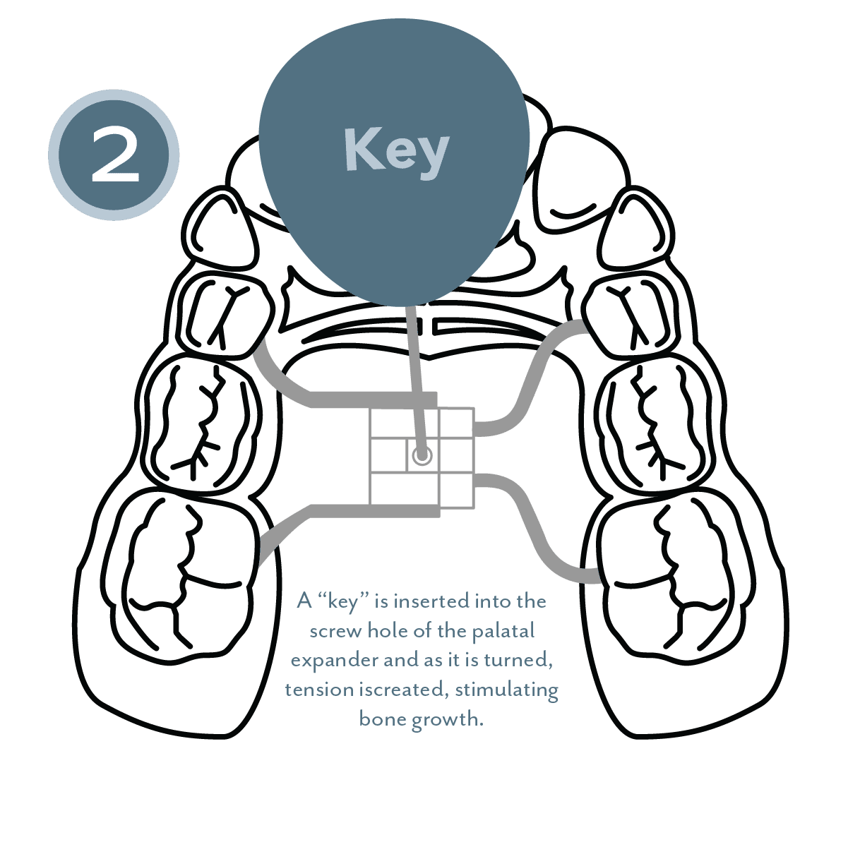 Key turns expander